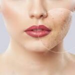 Macchie e cicatrici da acne, i rimedi naturali