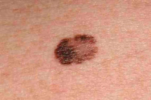Sale di 5 anni sopravvivenza per il melanoma