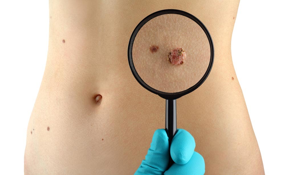 Cancro della pelle: i sintomi a cui prestare molta attenzione