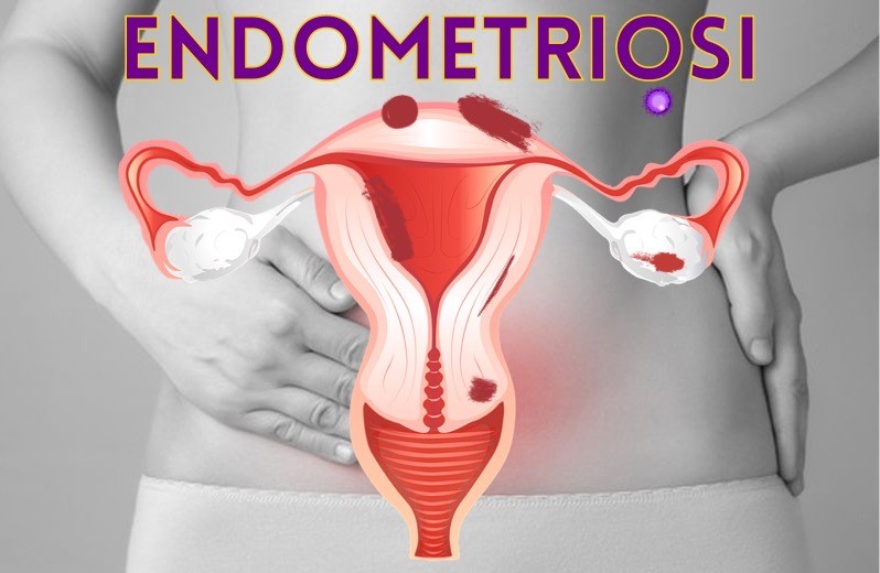 Endometriosi, una malattia sociale, non di genere