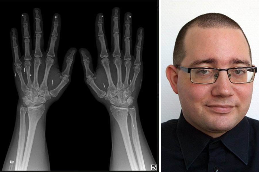 Uomo ha 32 chip sotto la pelle, paga avvicinando la mano al Pos