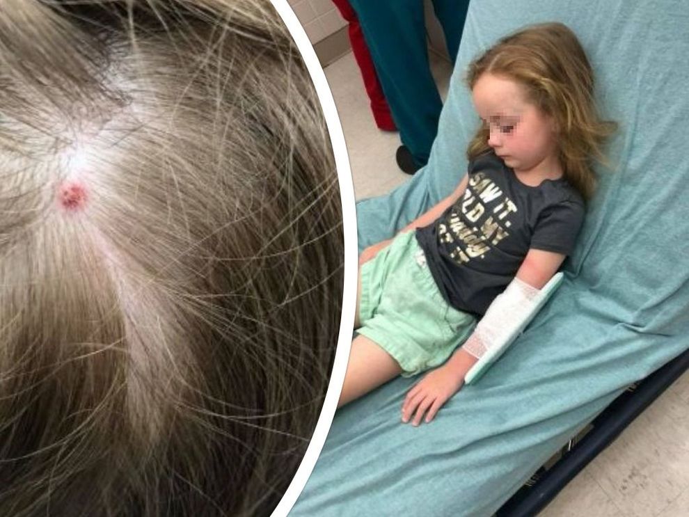 E’ allarme di Encefalite da zecche. Aggredisce il cervello in meno di 15 minuti