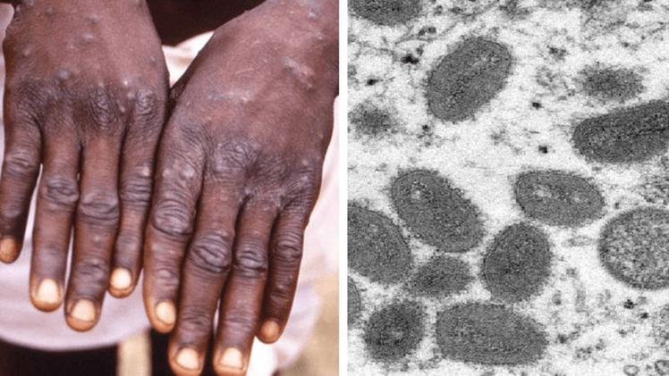 Vaiolo scimmie, dal Portogallo arriva la prima sequenza del genoma