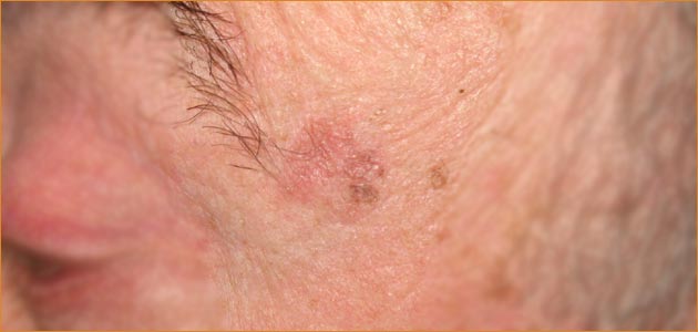 Al via la campagna di screening dermatologica gratuita