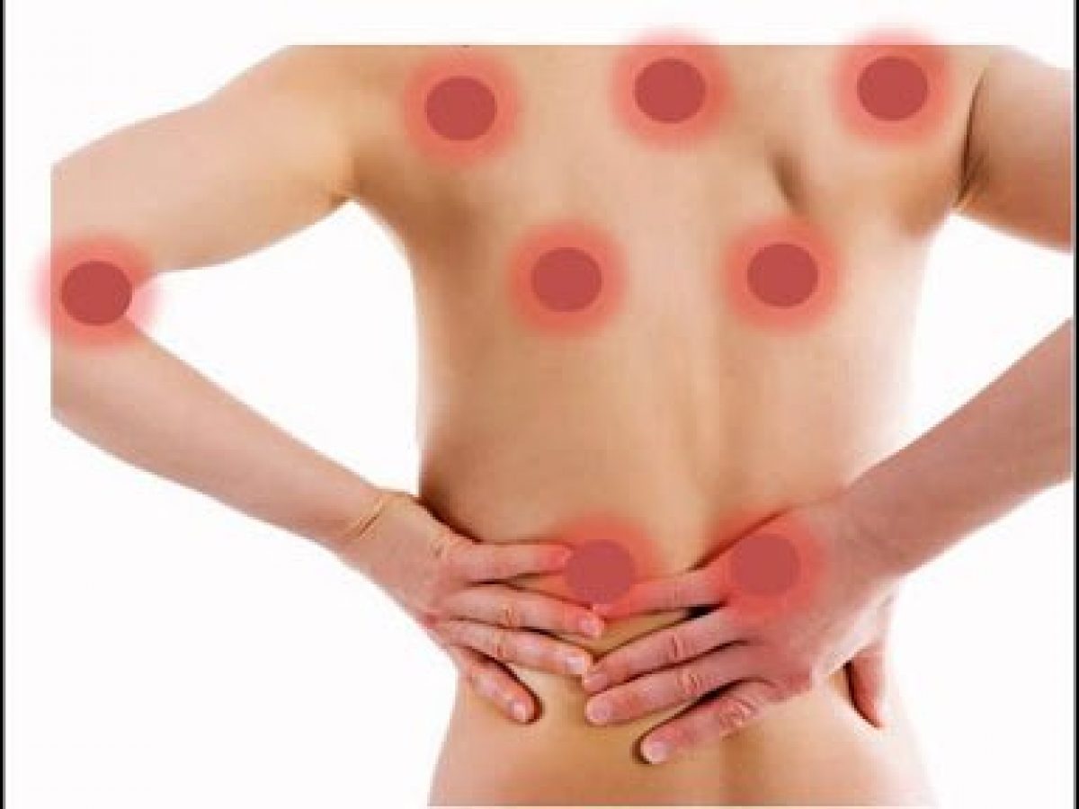 Fibromialgia